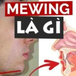 Mewing là gì