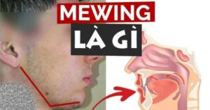 Mewing là gì