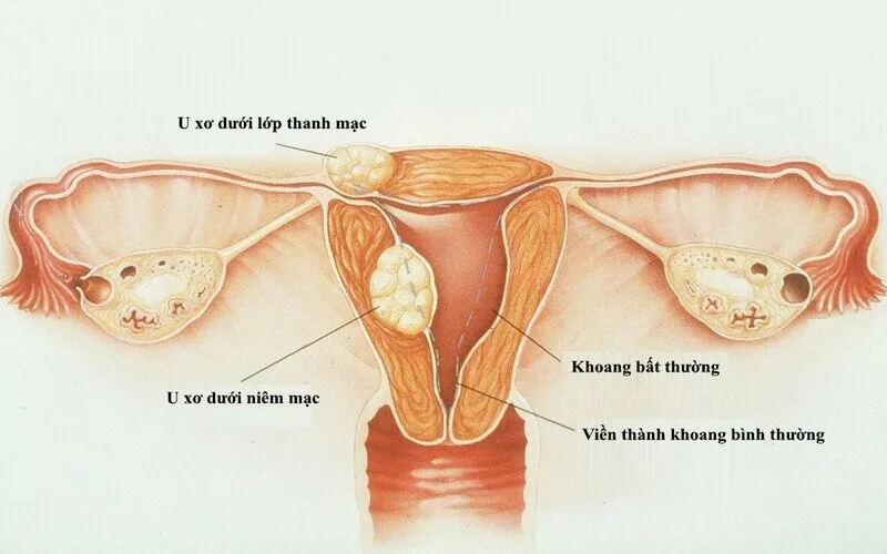 u xo tu cung la gi nhung dieu can biet de bao ve suc khoe sinh san